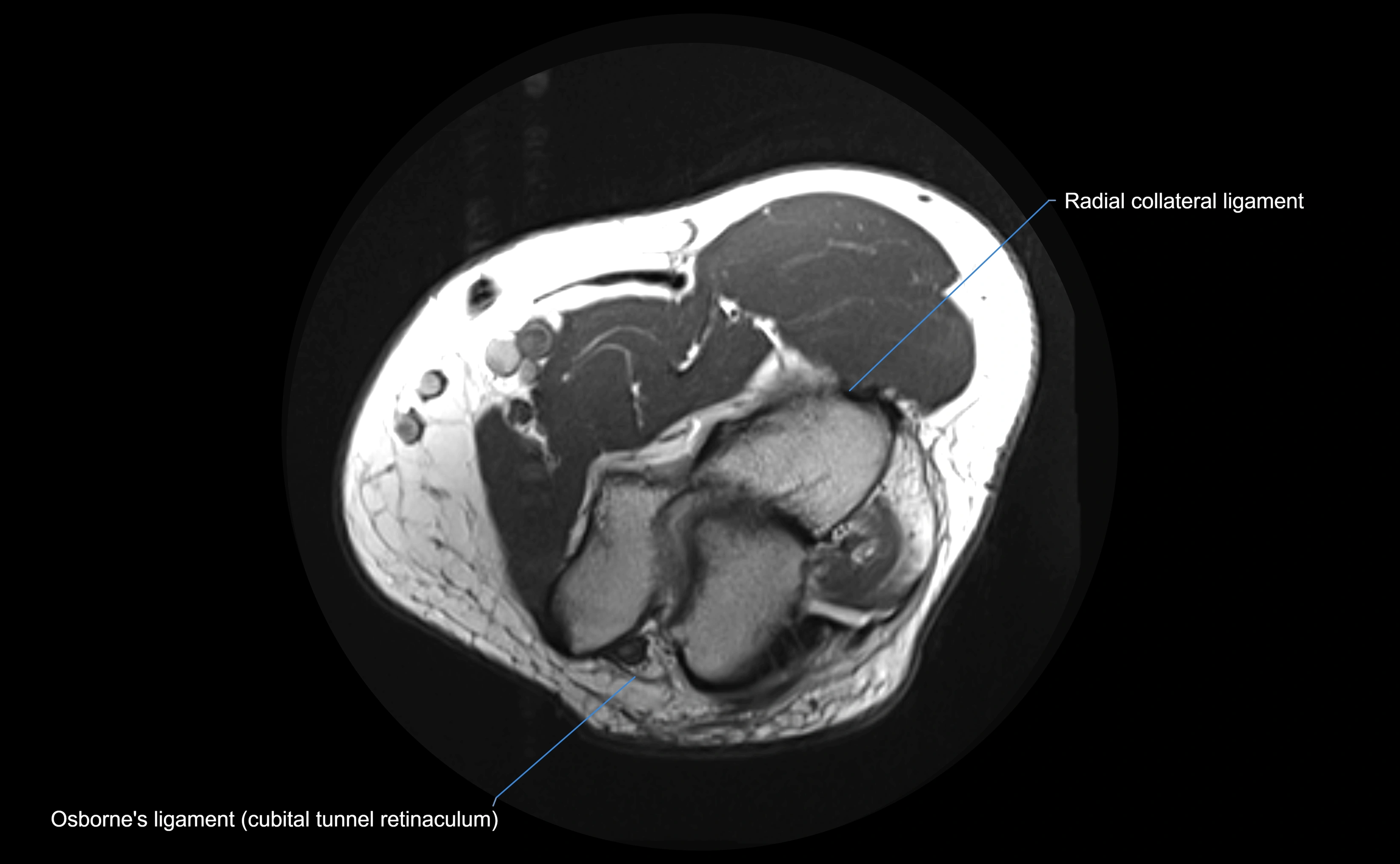 MRI elbow ligaments axial cross sectional anatomy 3T  radiology  image-img-00001-00011.webp